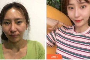 昆明國瑞整形美容醫(yī)院金昌義整形價(jià)格表附鼻部綜合案例展示