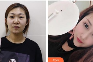 昆明夢(mèng)想醫(yī)療美容醫(yī)院李成龍整形價(jià)格表附切開雙眼皮案例展示