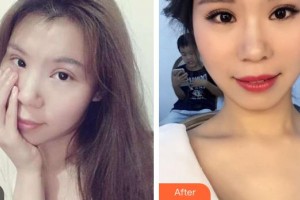 昆明市第一人民醫(yī)院星耀醫(yī)院合美紅整形價(jià)格表附切開雙眼皮案例展示