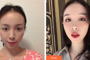 昆明韓辰整形醫(yī)院王陽整形價(jià)格表附眼部綜合案例展示