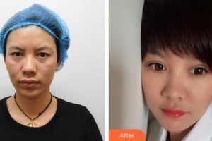昆明璀璨人生醫(yī)療美容診所李鴻軍整形價(jià)格表附切開雙眼皮案例展示