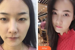 昆明璀璨人生醫(yī)療美容診所時(shí)保義整形價(jià)格表附開外眼角案例展示