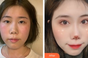 南寧達(dá)美整形美容醫(yī)院邢文明整形價(jià)格表附眼部手術(shù)案例展示
