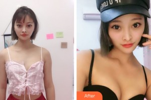 南寧夢想DREAM整形醫(yī)院劉正源整形價(jià)格表附自體脂肪豐胸案例展示