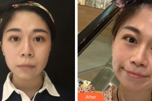 南寧市第一人民醫(yī)院整形美容外科黎寧整形價(jià)格表附皮膚美容案例展示