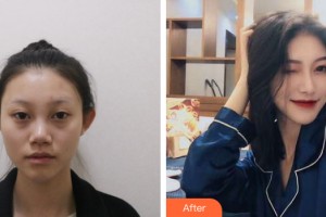 南寧市第一人民醫(yī)院整形美容外科磨思慧整形價(jià)格表附鼻部手術(shù)案例展示