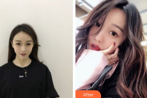 南寧悅美韓星醫(yī)療整形美容醫(yī)院蘇暉展整形價(jià)格表附皮膚美容案例展示