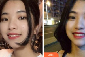南寧嶺南口腔診所梁月芬整形價(jià)格表附牙齒矯正案例展示