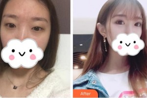 昆明普瑞眼科醫(yī)院岳以英整形價(jià)格表附定點(diǎn)雙眼皮案例展示