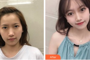 武漢美嘉整形美容醫(yī)院劉娟整形價格表附自體脂肪填充案例展示