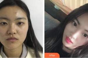 昆明阿瑪施眼科門診部翟國(guó)光整形價(jià)格表附切開(kāi)雙眼皮案例展示