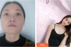 昆明康特森眼科醫(yī)院黎曉新整形價(jià)格表附眼部案例展示　