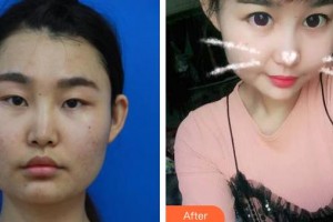 昆明阿瑪施眼科門診部陳寶芹整形價(jià)格表附眼部案例展示
