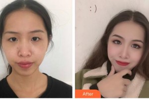 昆明拜博口腔醫(yī)院伍凱整形價(jià)格表附眼部案例展示　
