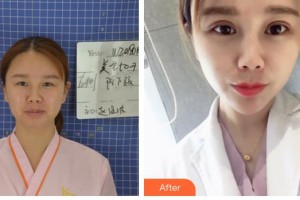 昆明眼科醫(yī)院任佑仁整形價(jià)格表附眼部綜合案例展示