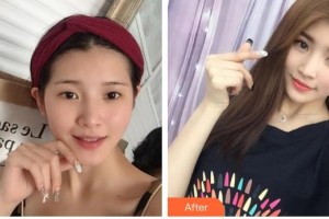 昆明拜博口腔醫(yī)院梁娜整形價(jià)格表附切開雙眼皮案例展示