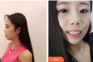 昆明藍(lán)橙口腔醫(yī)院彭靈整形價格表附牙貼面案例展示