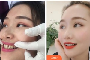 昆明先行口腔門診部戴文娟整形價(jià)格表附金屬托槽矯正案例展示