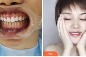 昆明尚愛韓美口腔門診部陸成華整形價格表附金屬托槽矯正案例展示