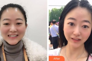 昆明市口腔醫(yī)院武鉞整形價格表附金屬托槽矯正案例展示