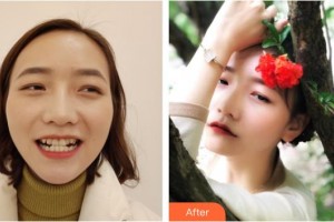 昆明醫(yī)科大學(xué)附屬口腔醫(yī)院億大口腔門診部魯志遠整形價格表附牙齒陶瓷矯正案例展示