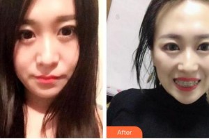 昆明醫(yī)科大學(xué)附屬口腔醫(yī)院億大口腔門診部盧榮整形價格表附牙齒隱形矯正案例展示