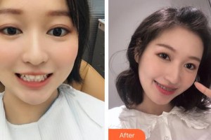 昆明醫(yī)科大學(xué)附屬口腔醫(yī)院億大口腔門診部李江波整形價格表附美白貼片案例展示