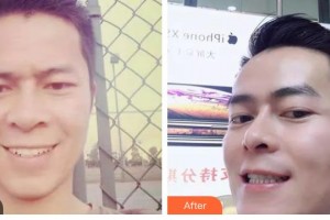 昆明愛雅仕口腔醫(yī)院趙雪菲整形價格表附金屬托槽矯正案例展示