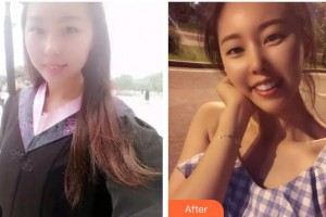 曲靖口腔醫(yī)院張華鳳整形價(jià)格表附牙齒陶瓷矯正案例展示