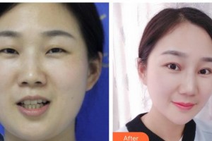 玉溪愛爾眼科醫(yī)院肖莉麗整形價格表附眼部綜合案例展示