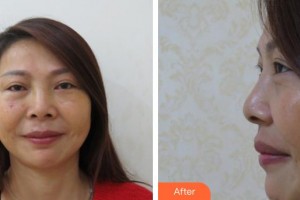 玉溪愛爾眼科醫(yī)院蘇銳整形價格表附眶隔脂肪釋放案例展示