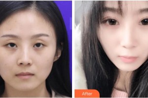 玉溪愛爾眼科醫(yī)院劉超整形價格表附眼部修復(fù)案例展示