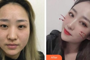 昭通愛(ài)麗諾醫(yī)療美容門(mén)診部段姍姍整形價(jià)格表附切開(kāi)雙眼皮案例展示