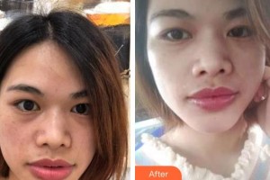 昭通愛麗諾醫(yī)療美容門診部唐文齊整形價格表附眼部修復(fù)案例展示