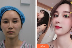 武漢鵬愛(ài)靜港醫(yī)療美容門診部陳晶整形價(jià)格表附鼻部手術(shù)案例展示