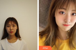 武漢仁愛時光醫(yī)院整形美容中心郭帥整形價格表附眼部手術案例展示