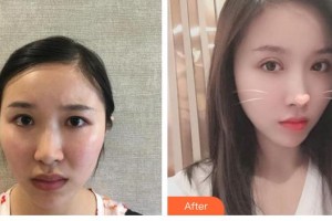 江蘇省第二中醫(yī)院眼科歐陽永斌整形價格表附眼部綜合案例展示