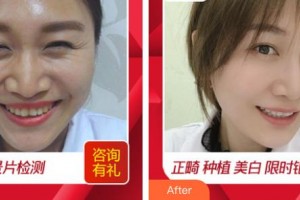 江蘇省口腔醫(yī)院倪杰整形價格表附冷光美白案例展示