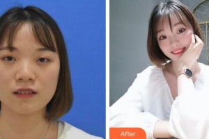 河北現(xiàn)代女子醫(yī)院整形美容中心翟奈穎整形價格表附定點(diǎn)雙眼皮案例展示