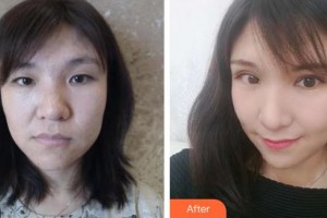 武警河北總隊醫(yī)院燒傷整形科王淑娟整形價格表附眼部綜合案例展示
