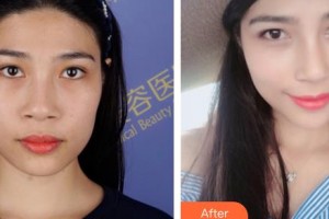 河北工程大學(xué)附屬醫(yī)院整形美容科袁好軍整形價格表附鼻部綜合案例展示