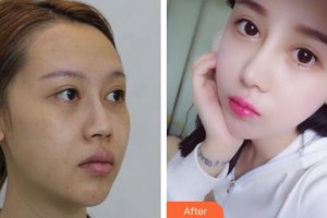 石家莊俏之翼醫(yī)療美容門(mén)診部穆寶安整形價(jià)格表附硅膠隆鼻案例展示
