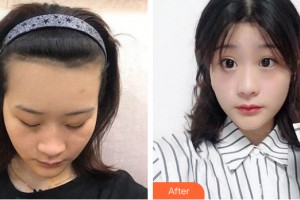 武漢美侖醫(yī)療美容門診部桂亮整形價格表附植發(fā)案例展示