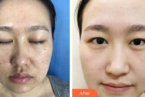 石家莊冀美醫(yī)療美容門診部耿麗娟整形價格表附微創(chuàng)疤痕修復(fù)案例展示