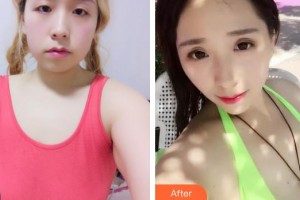 石家莊俏之翼醫(yī)療美容門診部鄭斌整形價(jià)格表附假體隆胸案例展示