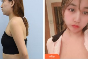 武漢沃美醫(yī)療美容門診部鹿永平整形價(jià)格表附自體脂肪豐胸案例展示
