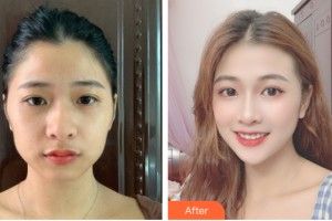 武漢沃美醫(yī)療美容門診部王斌整形價(jià)格表附自體脂肪填充案例展示