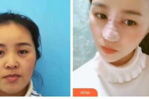 唐山開灤醫(yī)院整形美容中心閆貴春整形價格表附假體隆鼻案例展示