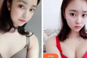 唐山美泉醫(yī)療美容診所王景鋒整形價格表附自體脂肪隆胸案例展示
