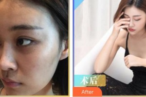 唐山金鳳凰美容整形醫(yī)院劉華濟(jì)整形價格表附自體脂肪隆胸案例展示